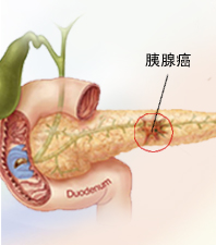 胰腺癌